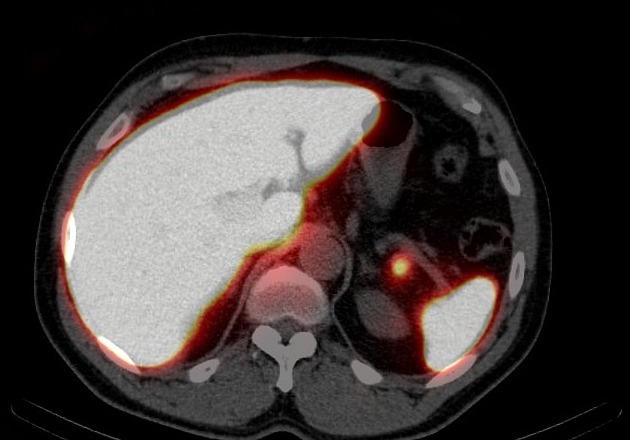 Tc-99m sulfur colloid | Radiology Reference Article | Radiopaedia.org