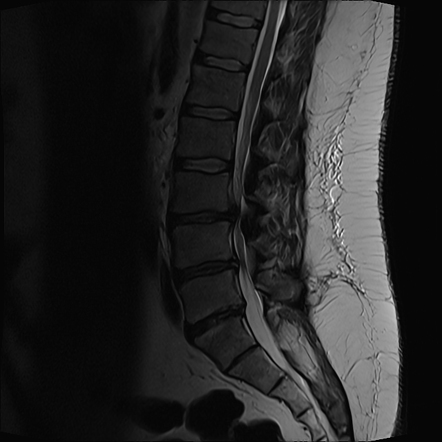 Cauda equina syndrome | Radiology Case | Radiopaedia.org