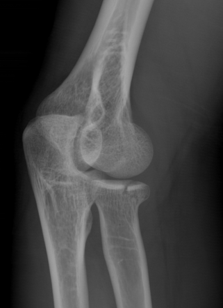 Radial head fracture | Radiology Case | Radiopaedia.org