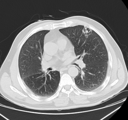 Congenital pulmonary airway malformation (CPAM) | Radiology Case ...