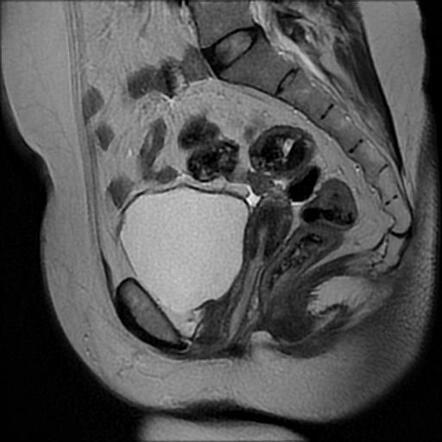 Prolapsed Endometrial Polyp Into Entire Vaginal Canal 