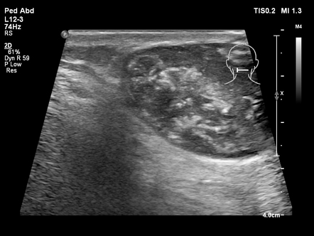 Pilomatricoma | Radiology Case | Radiopaedia.org