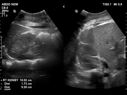 Hepatisation of the lung | Radiology Case | Radiopaedia.org