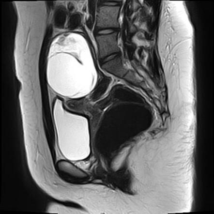 Ovarian dermoid cyst | Radiology Case | Radiopaedia.org