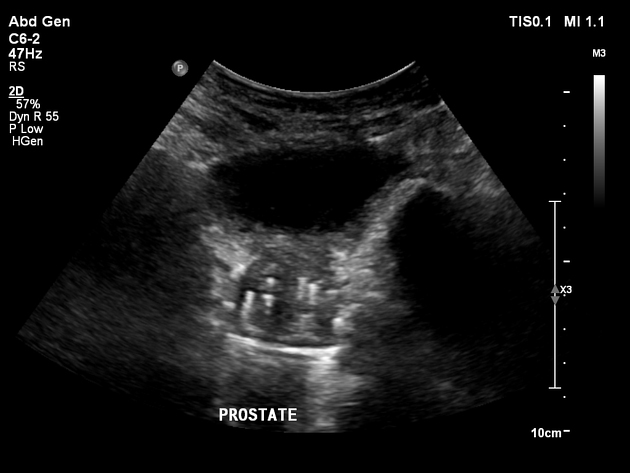 Ring down artefacts on abdominal sonography to predict pulmonary  abnormalities in the emergency department | Emergency Medicine Journal