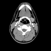 Submandibular gland enlargement | Radiology Reference Article ...