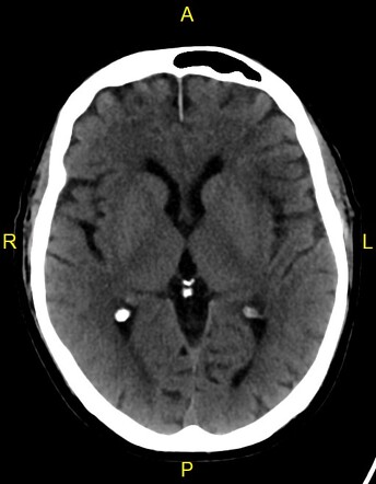 Early left MCA infarct | Radiology Case | Radiopaedia.org