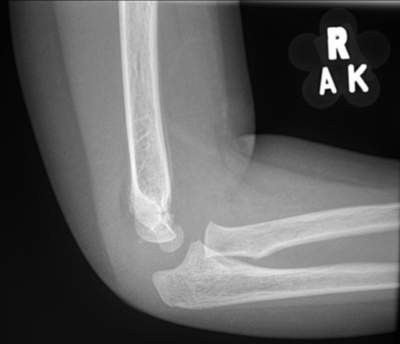 Supracondylar fracture of the humerus | Radiology Case | Radiopaedia.org