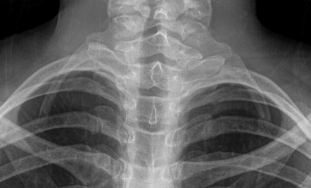 Cervical rib - bilateral | Radiology Case | Radiopaedia.org