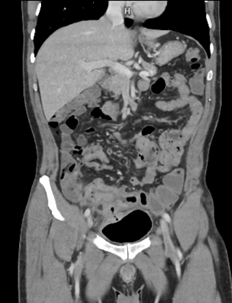 Sigmoid colon carcinoma with colovesical fistula | Radiology Case ...