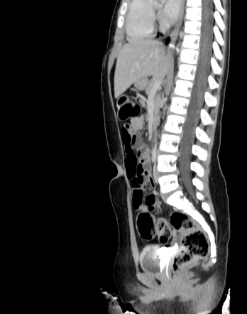 Vesicovaginal reflux | Radiology Case | Radiopaedia.org