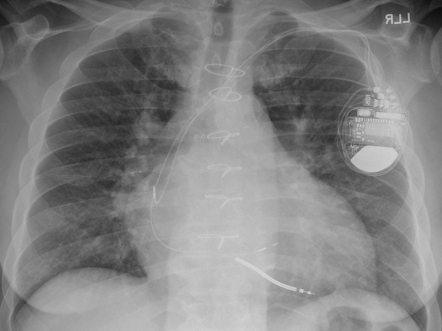 Wireless pulmonary artery pressure monitoring device | Radiology Case ...