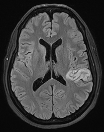 Acute left parietal infarct | Radiology Case | Radiopaedia.org