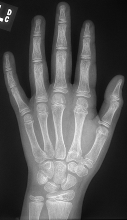 Torus Fracture - Second Metacarpal 