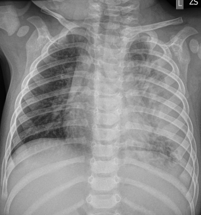 Pleural empyema | Radiology Case | Radiopaedia.org