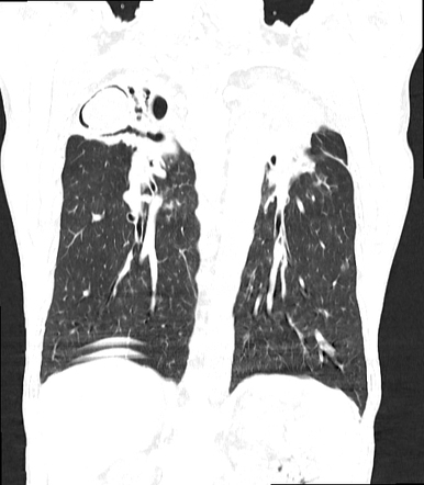 Tuberculous cavity with aspergilloma | Radiology Case | Radiopaedia.org