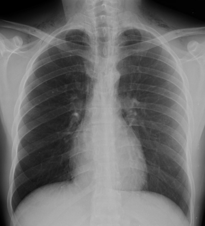 Pneumomediastinum and subcutaneous emphysema | Radiology Case ...