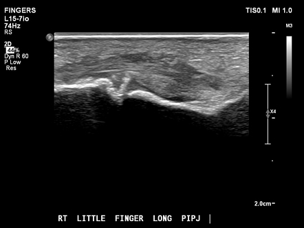 Volar plate avulsion fracture | Radiology Case | Radiopaedia.org