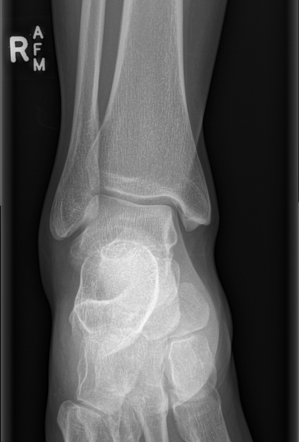 Lateral process talar fracture | Radiology Case | Radiopaedia.org