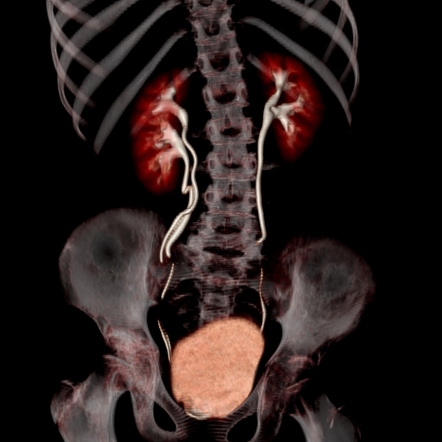 Complete ureteral duplication | Radiology Case | Radiopaedia.org