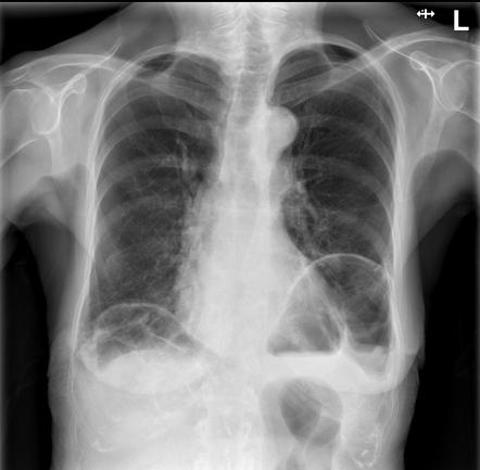 Raised hemidiaphragm with Chilaiditi sign | Radiology Case ...