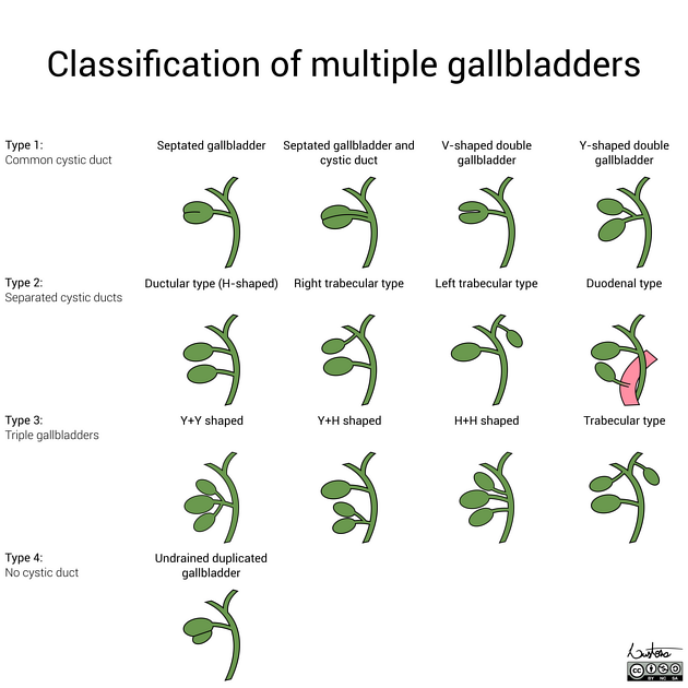 Classification of multiple gallbladders | Radiology Case