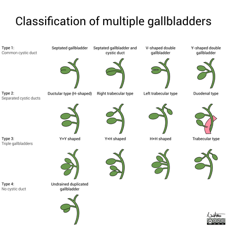 Classification of multiple gallbladders | Radiology Case | Radiopaedia.org