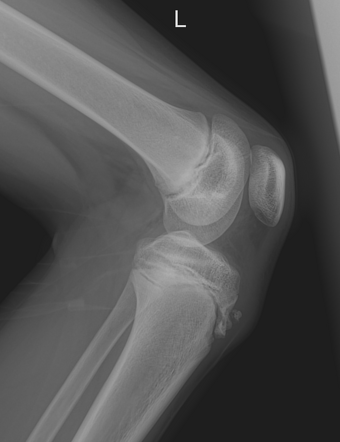 Osgood-Schlatter disease | Radiology Case | Radiopaedia.org