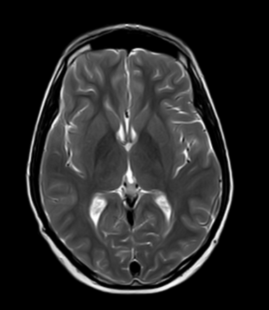 Pineal germinoma with diffuse subependymal tumour spread | Radiology ...