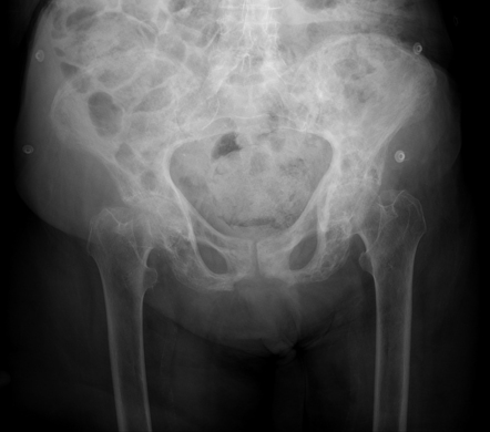 Paget disease- pelvis | Radiology Case | Radiopaedia.org