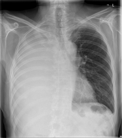 Massive pleural effusion | Radiology Case | Radiopaedia.org