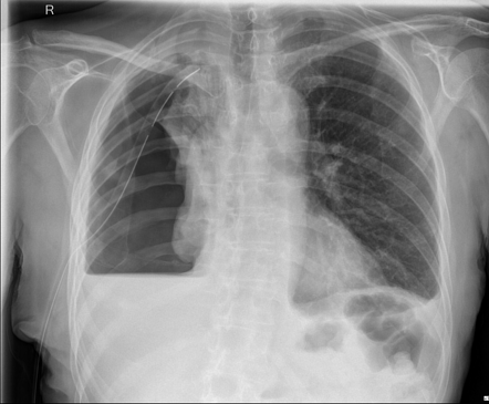 Iatrogenic hydropneumothorax | Radiology Case | Radiopaedia.org