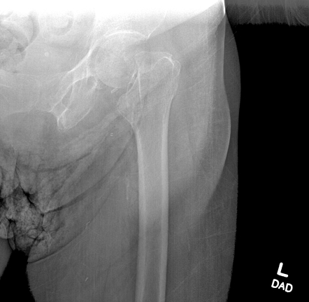 Femoral subcapital neck fracture | Radiology Case | Radiopaedia.org