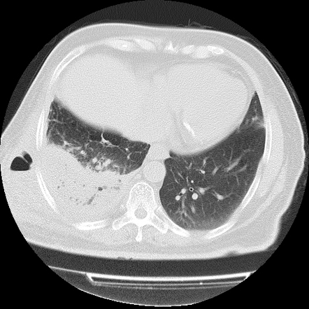 Empyema necessitans | Radiology Case | Radiopaedia.org