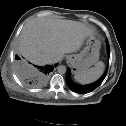 Empyema necessitans | Radiology Case | Radiopaedia.org