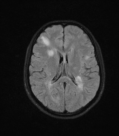 Multiple Sclerosis Radiology Case Radiopaedia Org