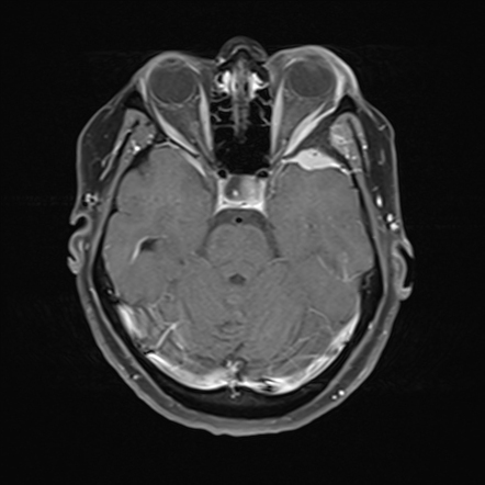 En plaque meningioma | Radiology Case | Radiopaedia.org