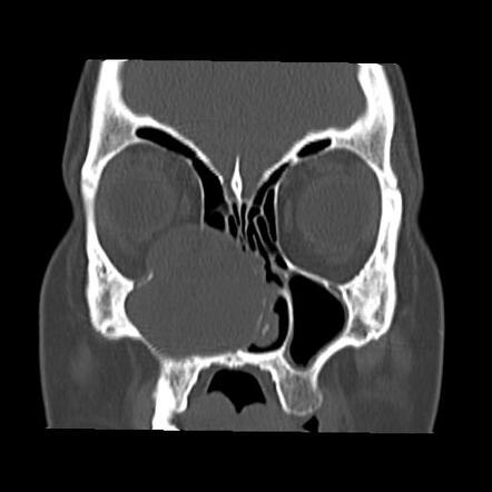 Maxillary sinus mucocele | Radiology Case | Radiopaedia.org