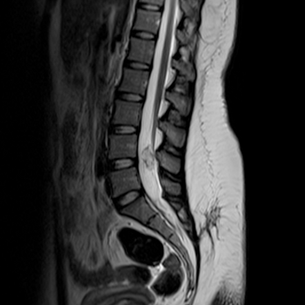 Dorsal Dermal Sinus - With Spinal Inclusion Cyst And Tethered Cord 