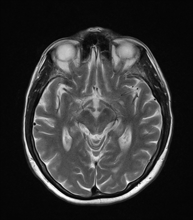 Progressive Supranuclear Palsy | Radiology Case | Radiopaedia.org