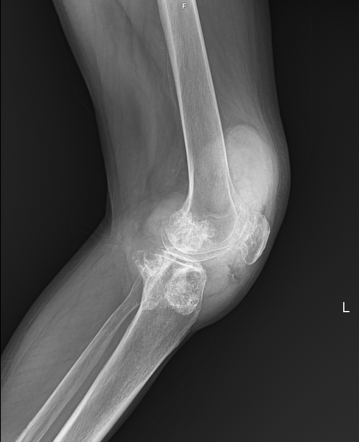 Gout | Radiology Reference Article | Radiopaedia.org