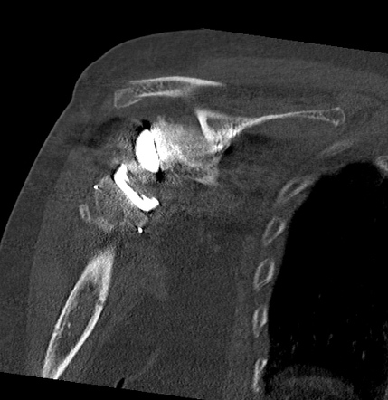 Acromial fracture post reverse total shoulder arthroplasty | Radiology ...