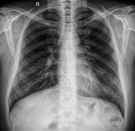 Oil cysts - male breasts (chest x-ray) | Radiology Case | Radiopaedia.org