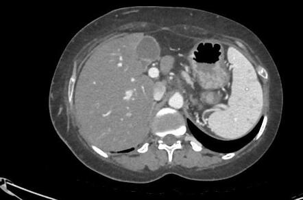 Splenic granulomas | Radiology Case | Radiopaedia.org