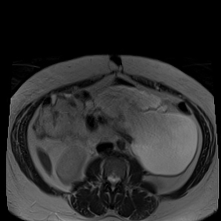 Endometriosis, adenomyosis, and peritoneal inclusion cyst | Radiology ...