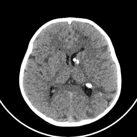 Tuberous sclerosis | Radiology Case | Radiopaedia.org