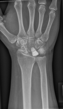 Lunate replacement | Radiology Case | Radiopaedia.org