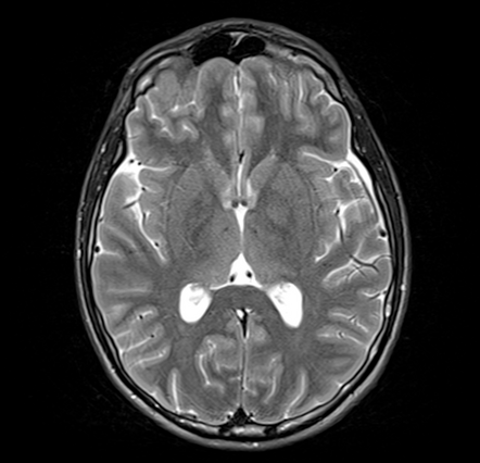 Focal areas of signal intensity (FASI) - neurofibromatosis type 1 ...