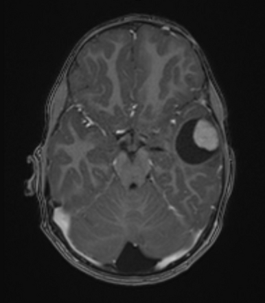 Pleomorphic xanthoastrocytoma | Radiology Case | Radiopaedia.org