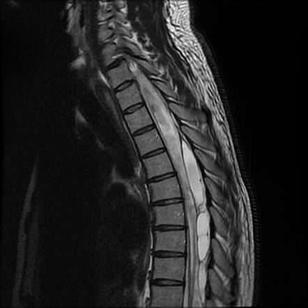 Spinal arachnoid cyst compressing the spinal cord with syrinx ...